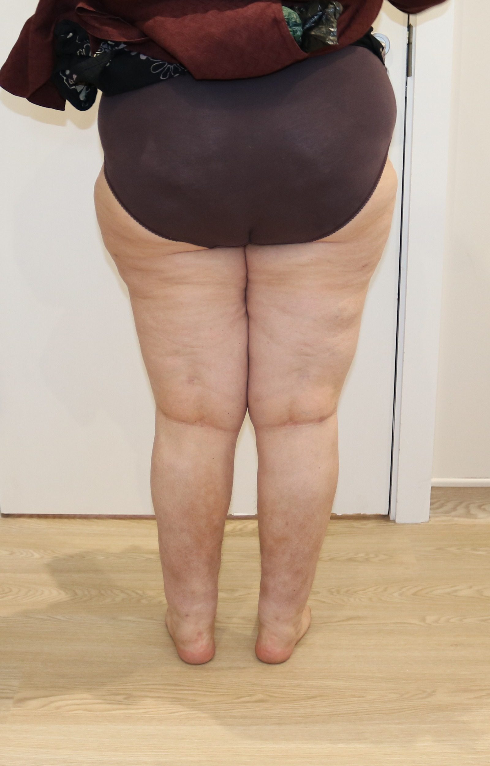 Lipoedema Type III Stage II after posterior view 1