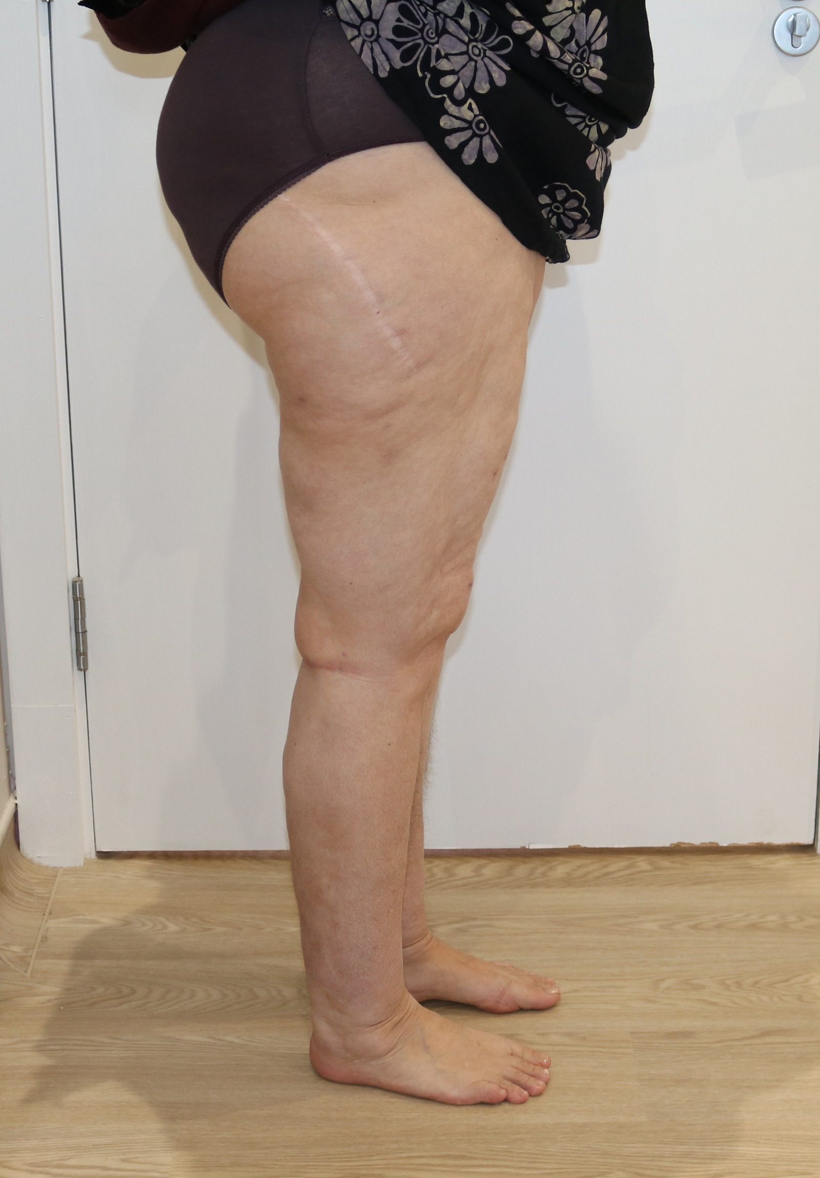 Lipoedema Type III Stage II after right lateral 1