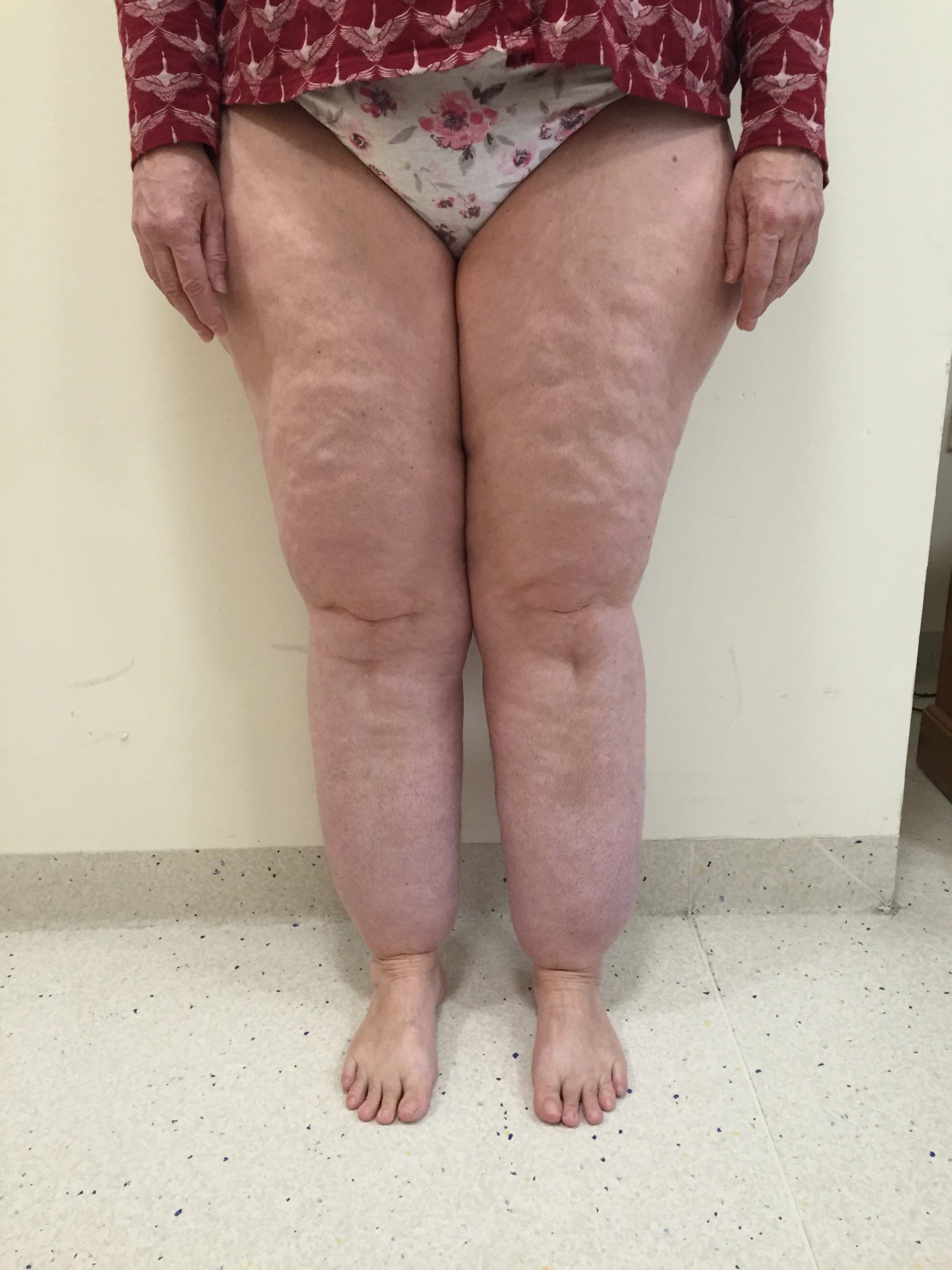 Lipoedema Type III Stage II before AP view 1 e 1501398806809 scaled