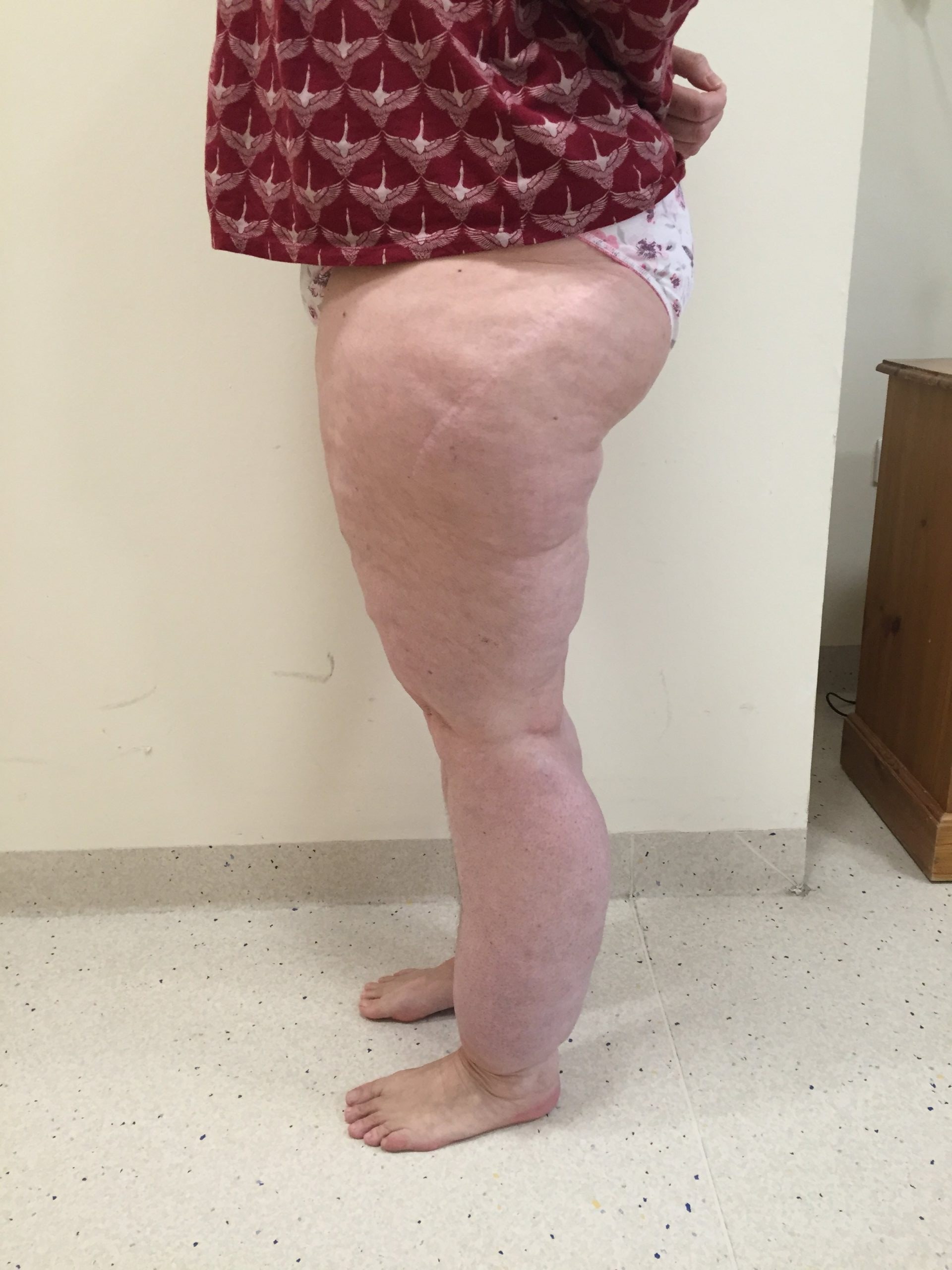 Lipoedema Type III Stage II before left lateral 1 e 1501398862410 scaled