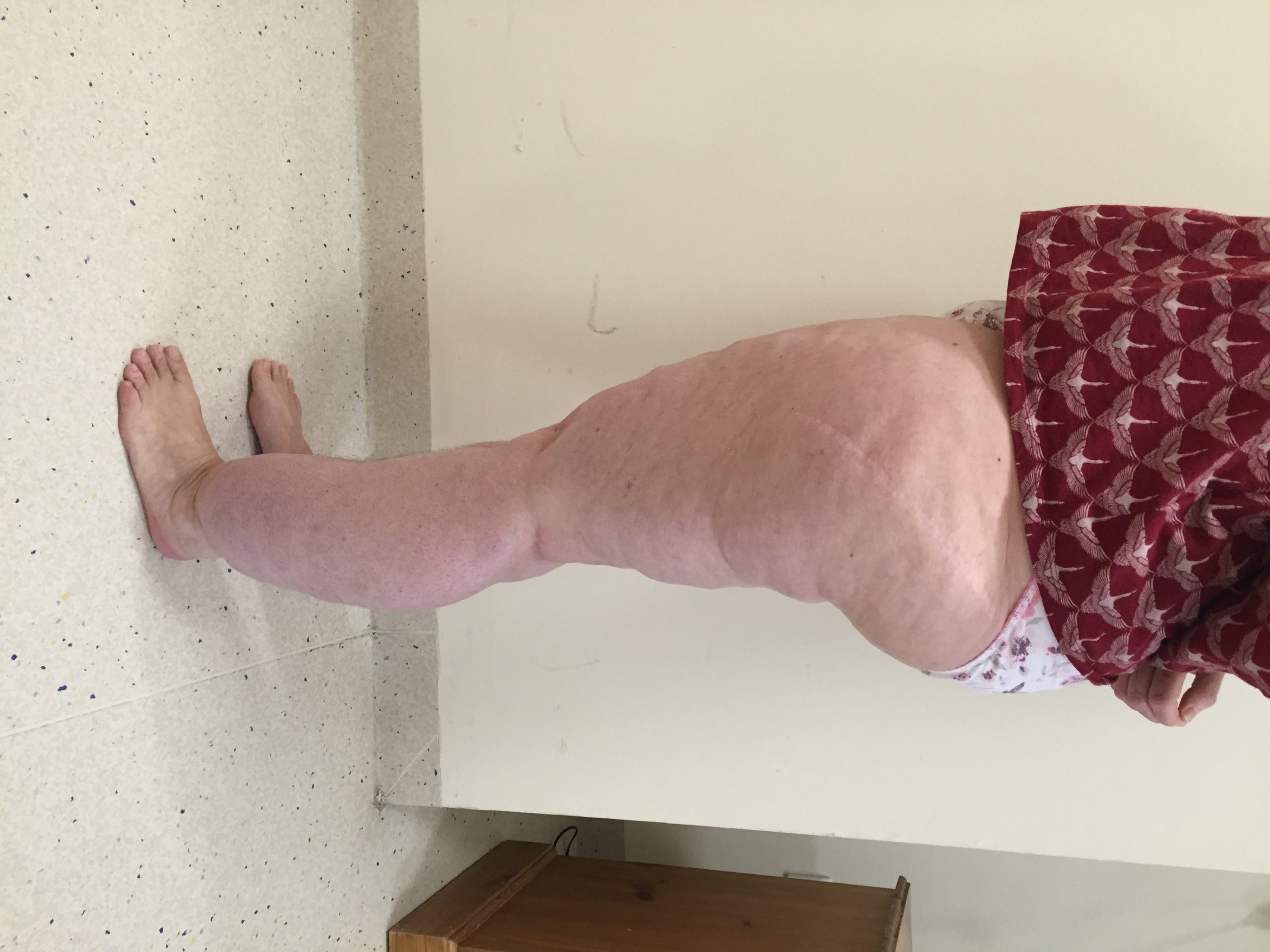 Lipoedema Type III Stage II before left lateral 1 e 1501398862410 scaled