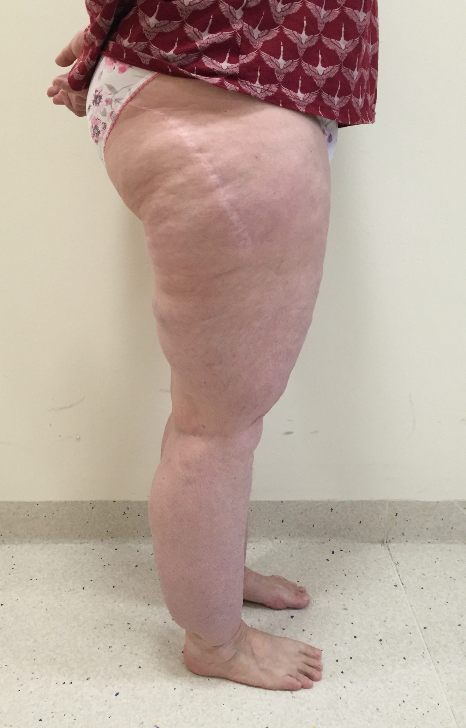 Lipoedema Type III Stage II before right lateral 1
