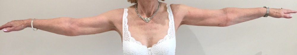 Lipoedema arms after AP view