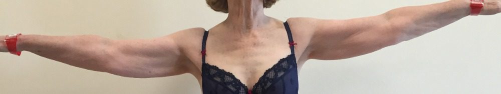 Lipoedema arms before AP view