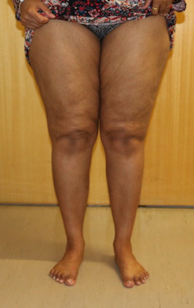 Lipoedema liposuction Type II after AP view