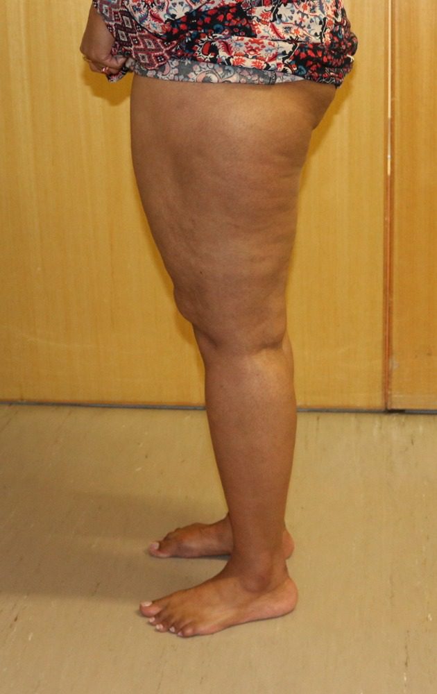 Lipoedema liposuction Type II after left lateral