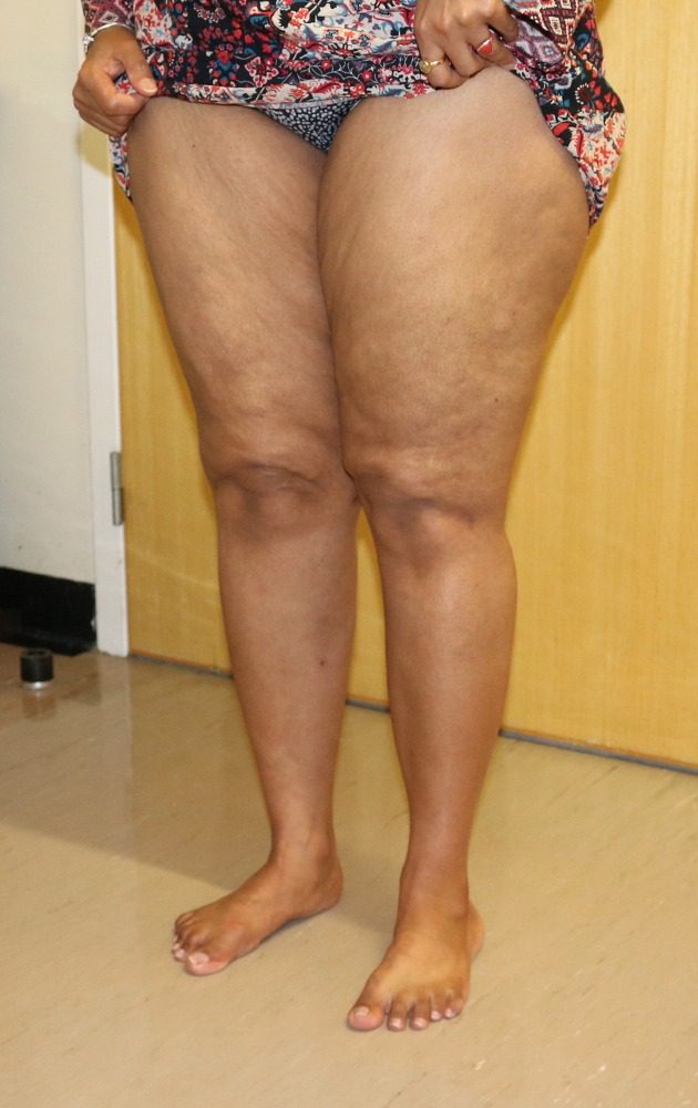 Lipoedema liposuction Type II after left oblique