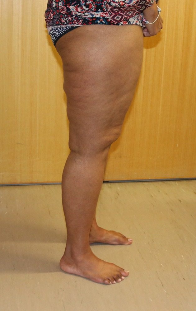 Lipoedema liposuction Type II after right lateral