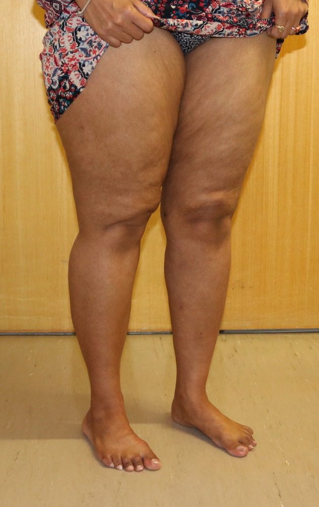 Lipoedema liposuction Type II after right oblique