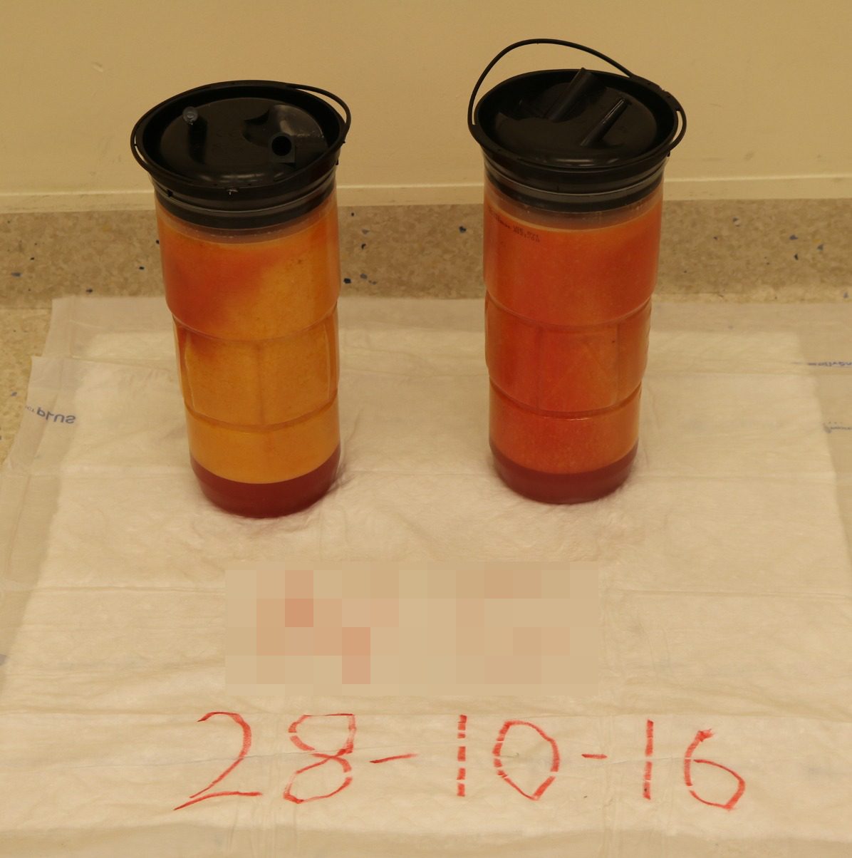 Lipoedema liposuction Type II aspirated fat