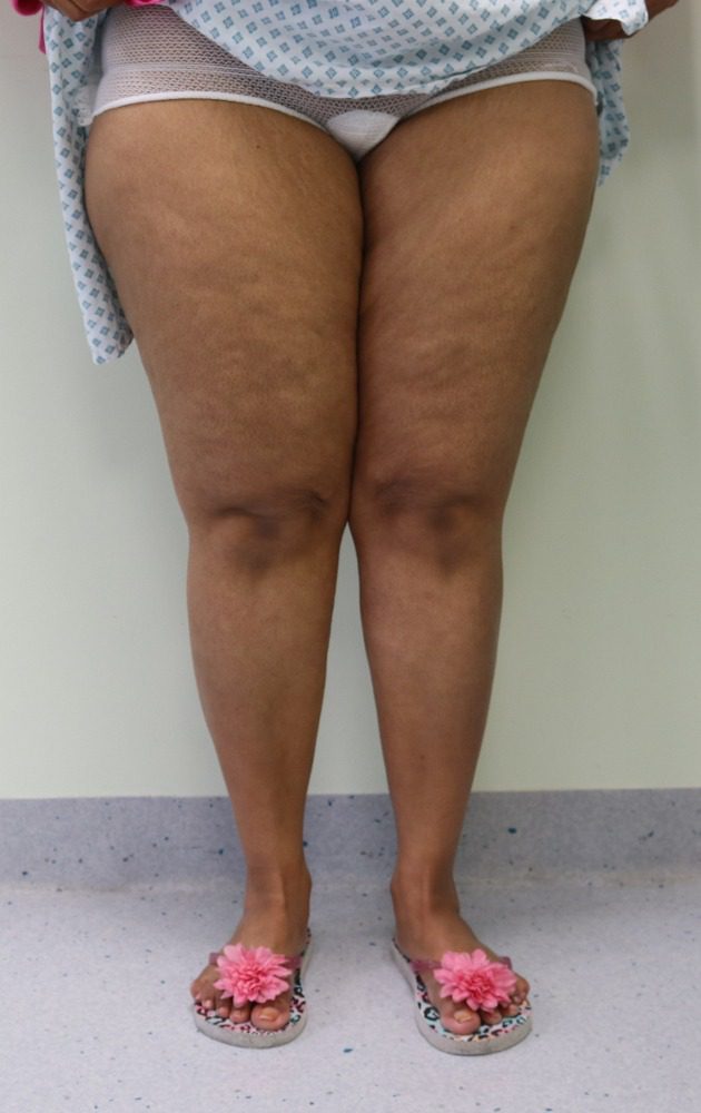 Lipoedema liposuction Type II before AP view