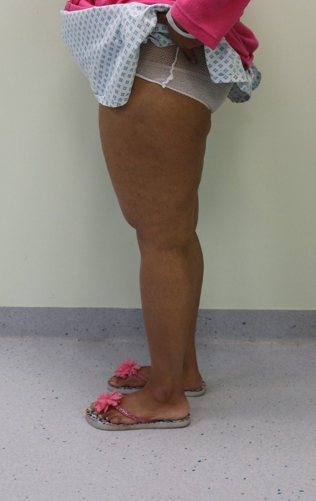 Lipoedema liposuction Type II before left lateral