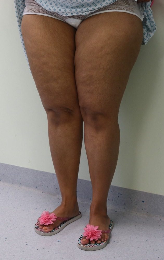 Lipoedema liposuction Type II before left oblique