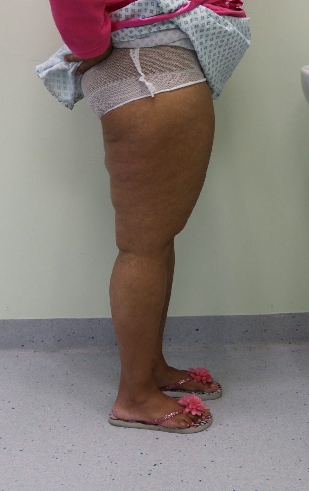 Lipoedema liposuction Type II before right lateral