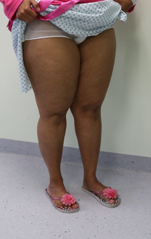 Lipoedema liposuction Type II before right oblique