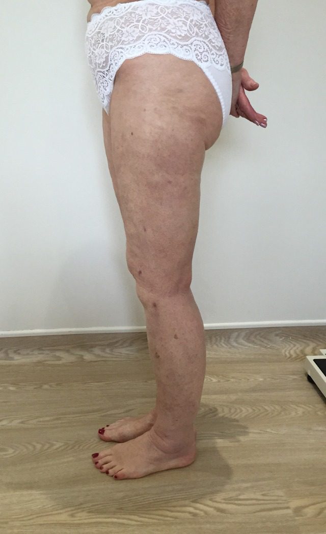 Lipoedema lower limbs after left lateral