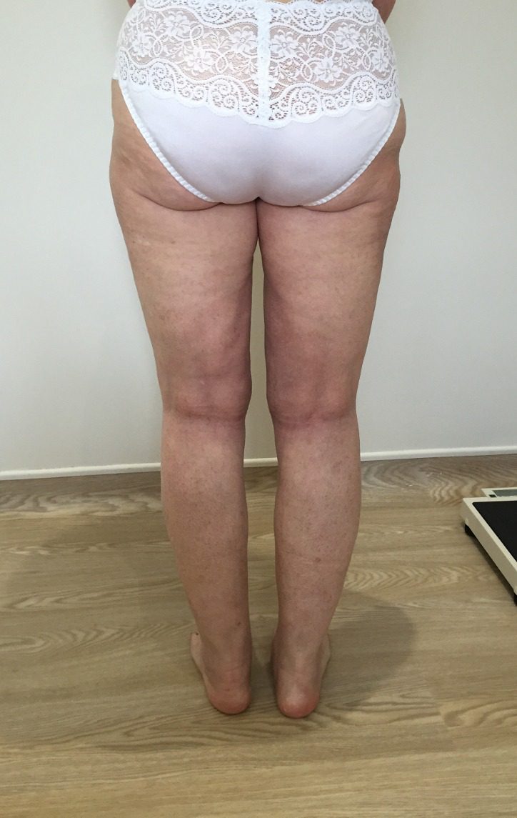 Lipoedema lower limbs after posterior view