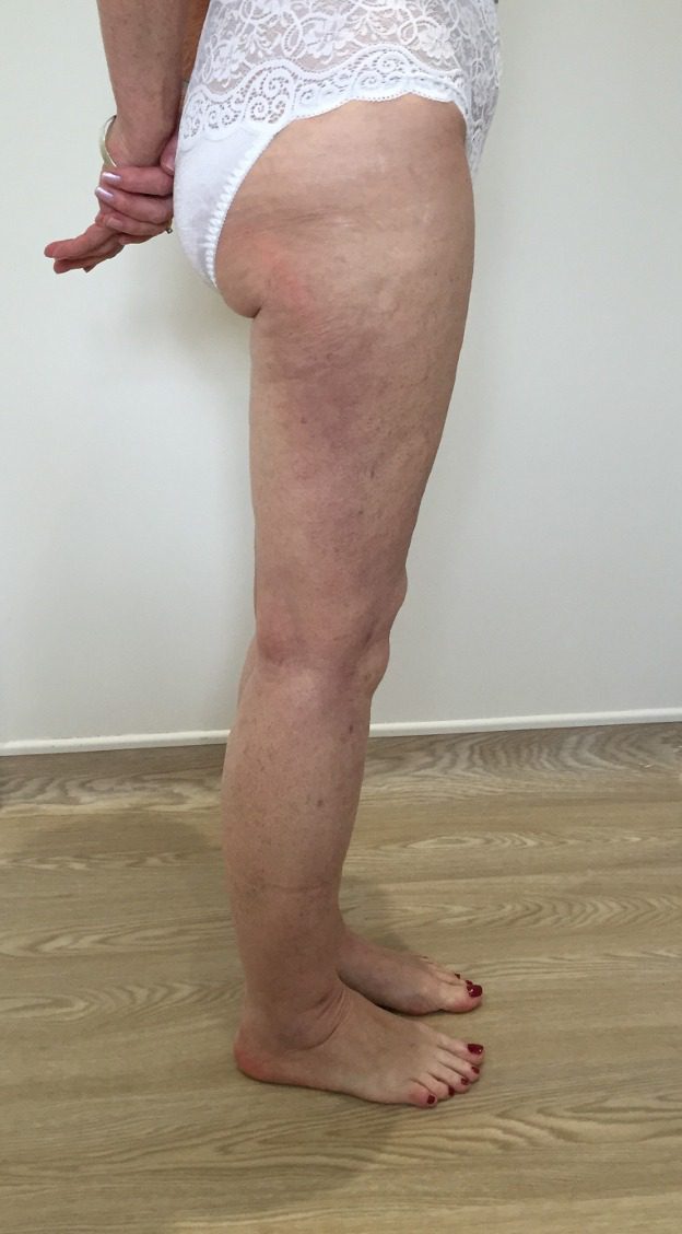 Lipoedema lower limbs after right lateral