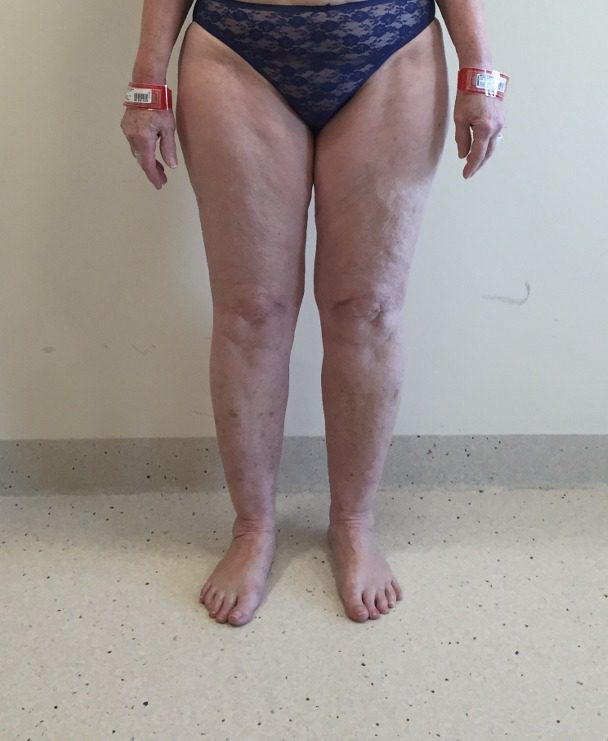 Lipoedema lower limbs before AP view