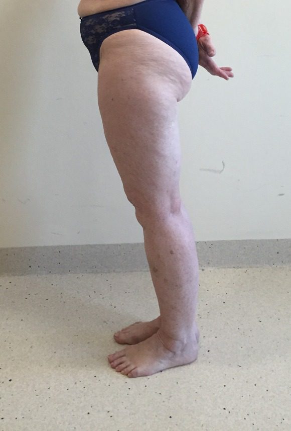 Lipoedema lower limbs before left lateral