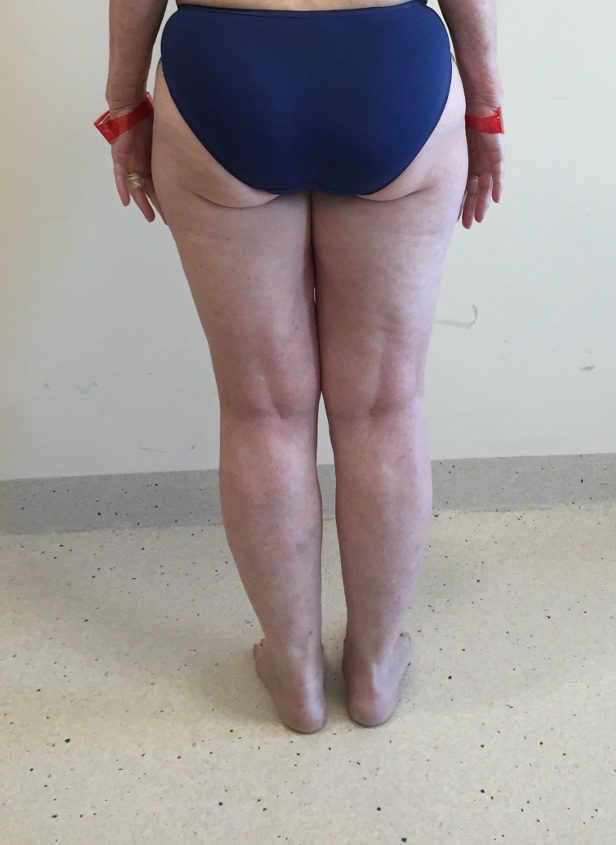 Lipoedema lower limbs before posterior view