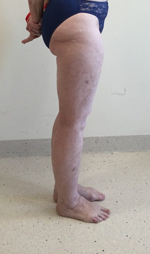 Lipoedema lower limbs before right lateral