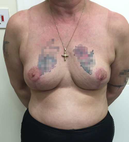 Mastopexy post op AP view 1