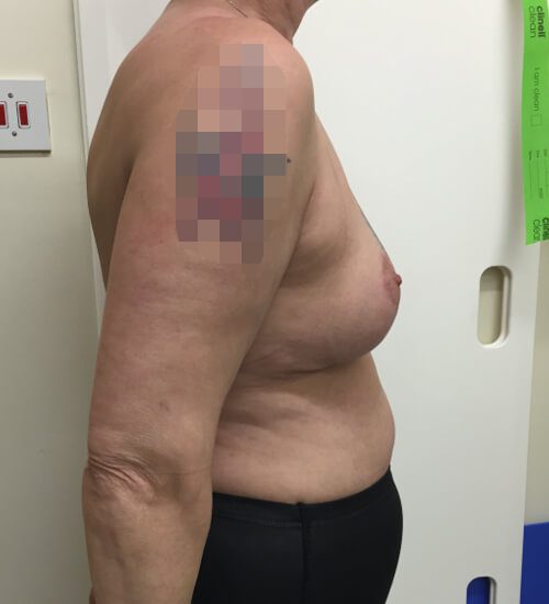 Mastopexy post op right lateral