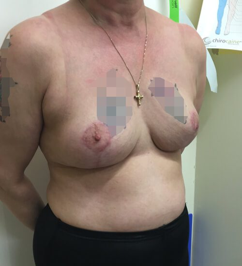Mastopexy post op right oblique