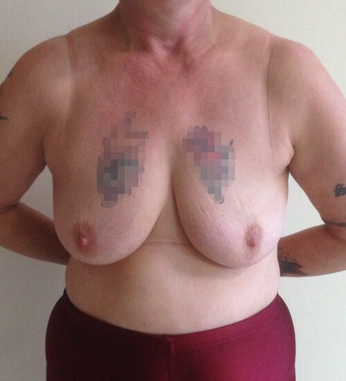 Mastopexy pre op AP view 1