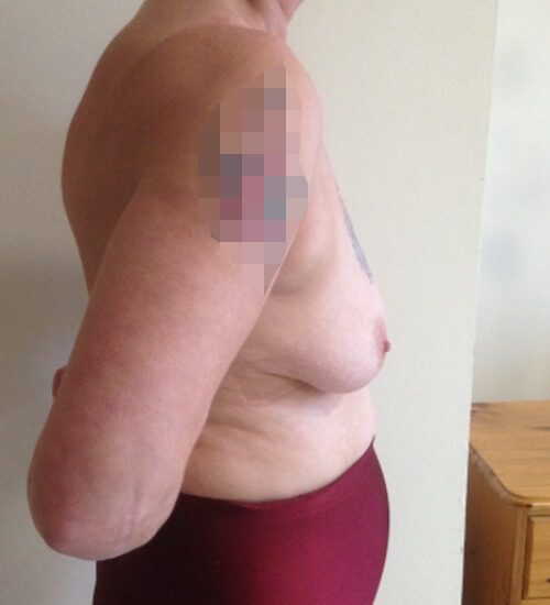 Mastopexy pre op right lateral