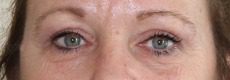 Upper blepharoplasty post op AP view