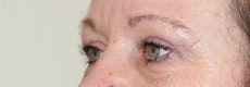 Upper blepharoplasty post op left oblique