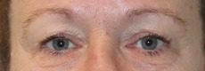 Upper blepharoplasty pre op AP view