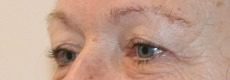 Upper blepharoplasty pre op left oblique