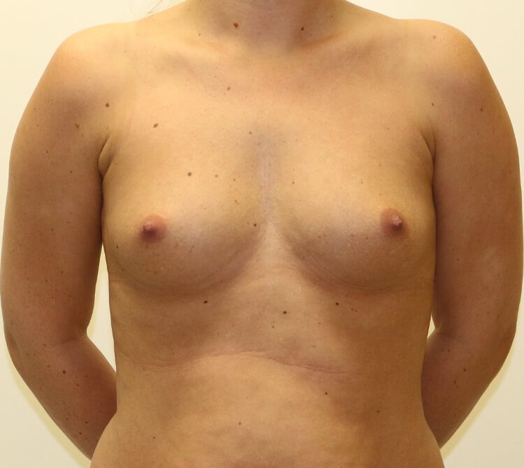 Breast enlargement before AP view 1