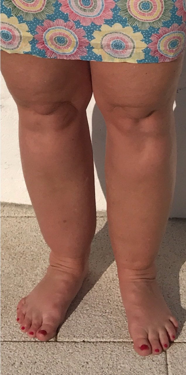 Lipoedema before and after 1 e 1503783426462