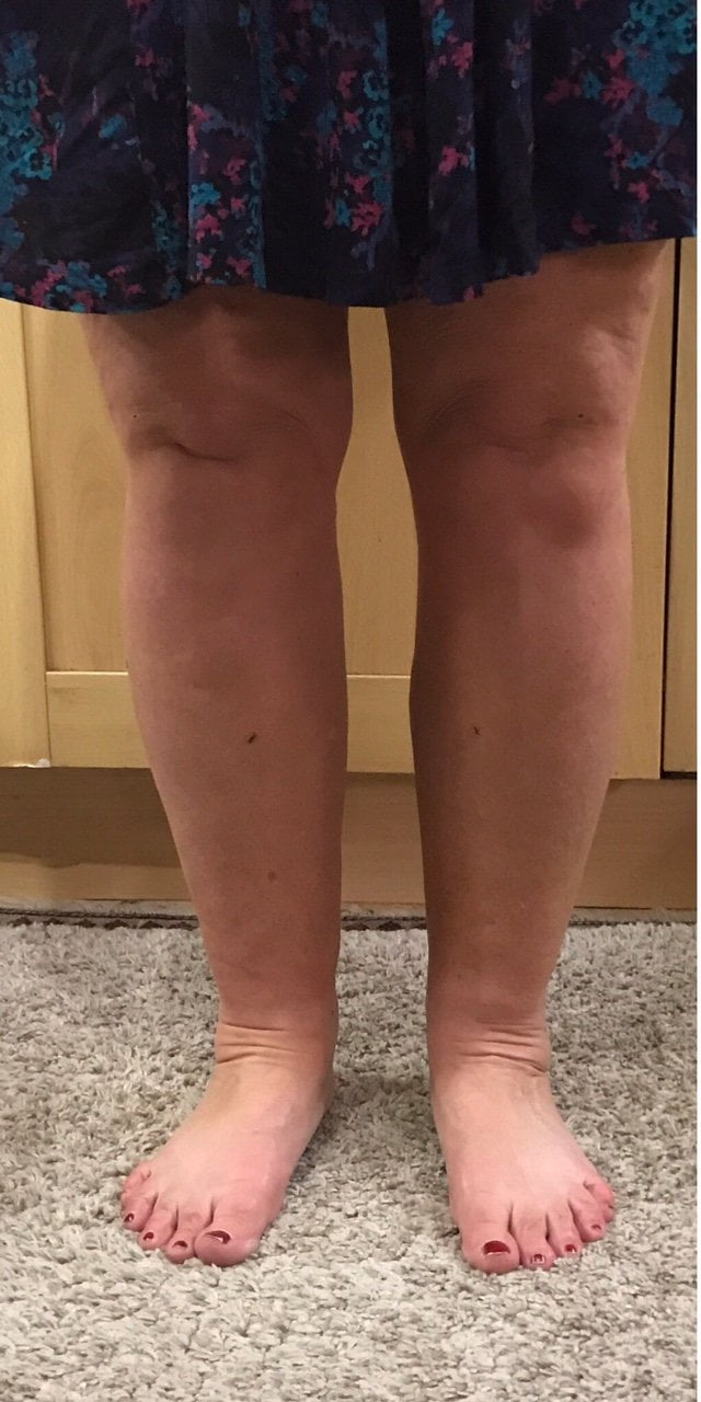 Lipoedema before and after e 1503783244722