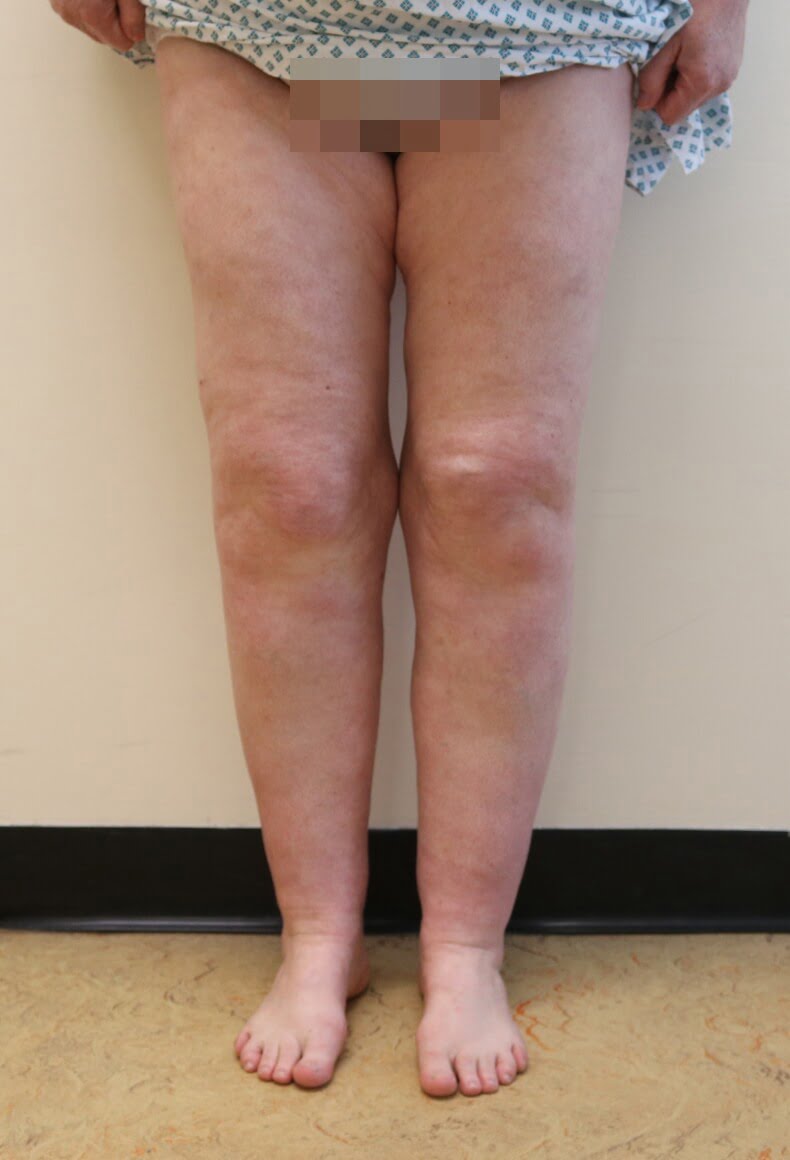 Lower limb lipoedema liposuction before AP view The Karri Clinic
