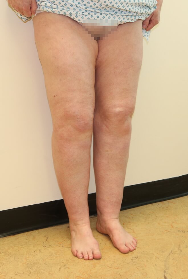 Lower limb lipoedema liposuction before right oblique The Karri Clinic