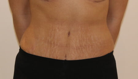 Tummy tuck after AP view
