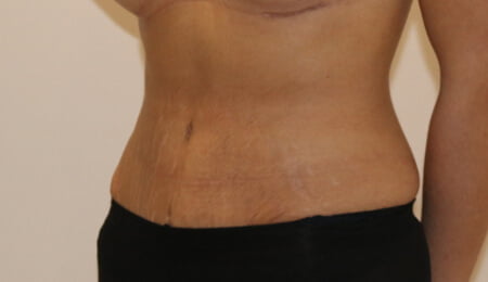 Tummy tuck after left oblique