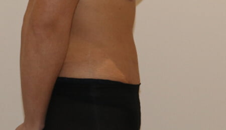 Tummy tuck after right lateral