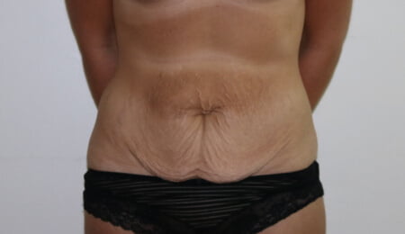 Tummy tuck before AP view