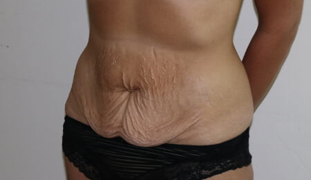 Tummy tuck before left oblique