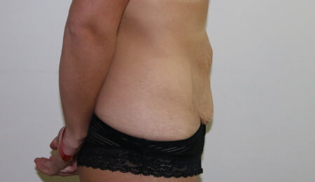 Tummy tuck before right lateral
