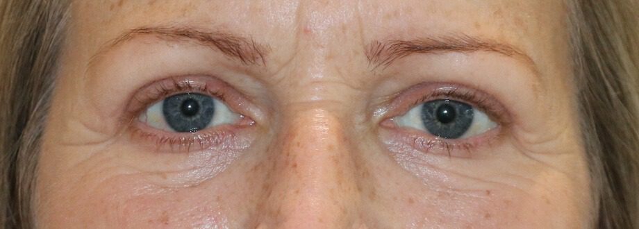 Upper blepharoplasty after AP view