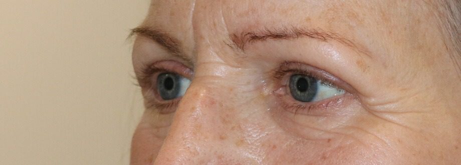 Upper blepharoplasty after left oblique