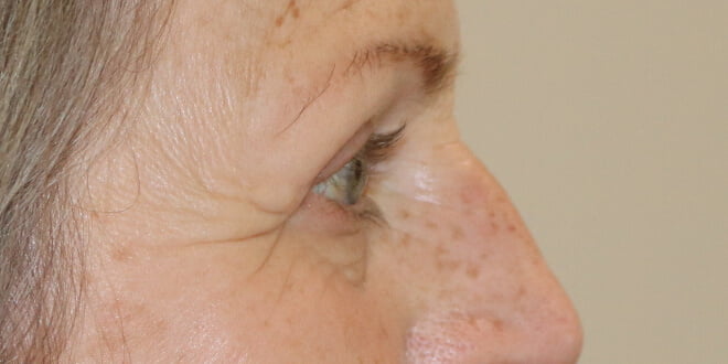 Upper blepharoplasty after right lateral