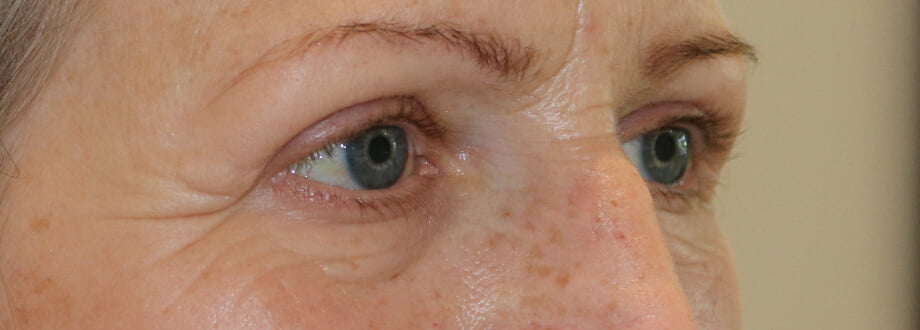 Upper blepharoplasty after right oblique